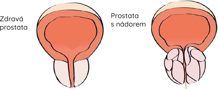 prsakoule